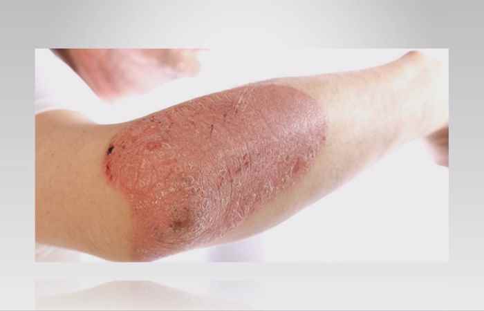 Sống khỏe 360 - Vảy nến có điều trị hết không? (30-12-2020)